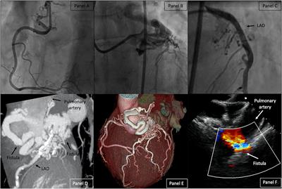 Frontiers Case Report Coronary Pulmonary Fistula Closure By